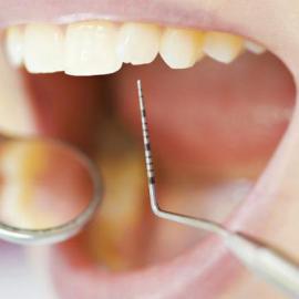 Лікування періодонтиту