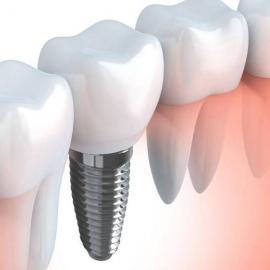 Протезирование на имплантатах