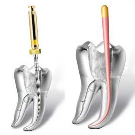 Лікування кореневих каналів (Ендодонтія)