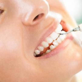 Професійне чищення зубів